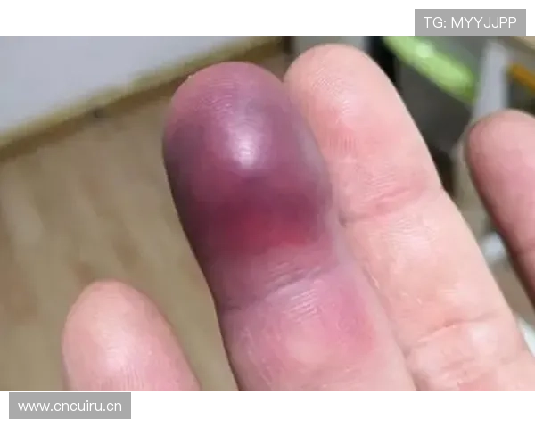 奥布拉克手指伤长期影响